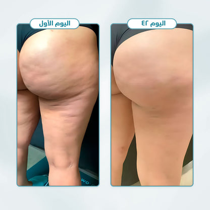 مجموعة Wellness™ لتخفيف السيلوليت